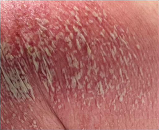 Pustulant Rash Clinical Infectious Diseases Society Update Book 2025